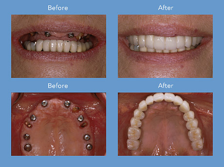 long recovery teeth implants